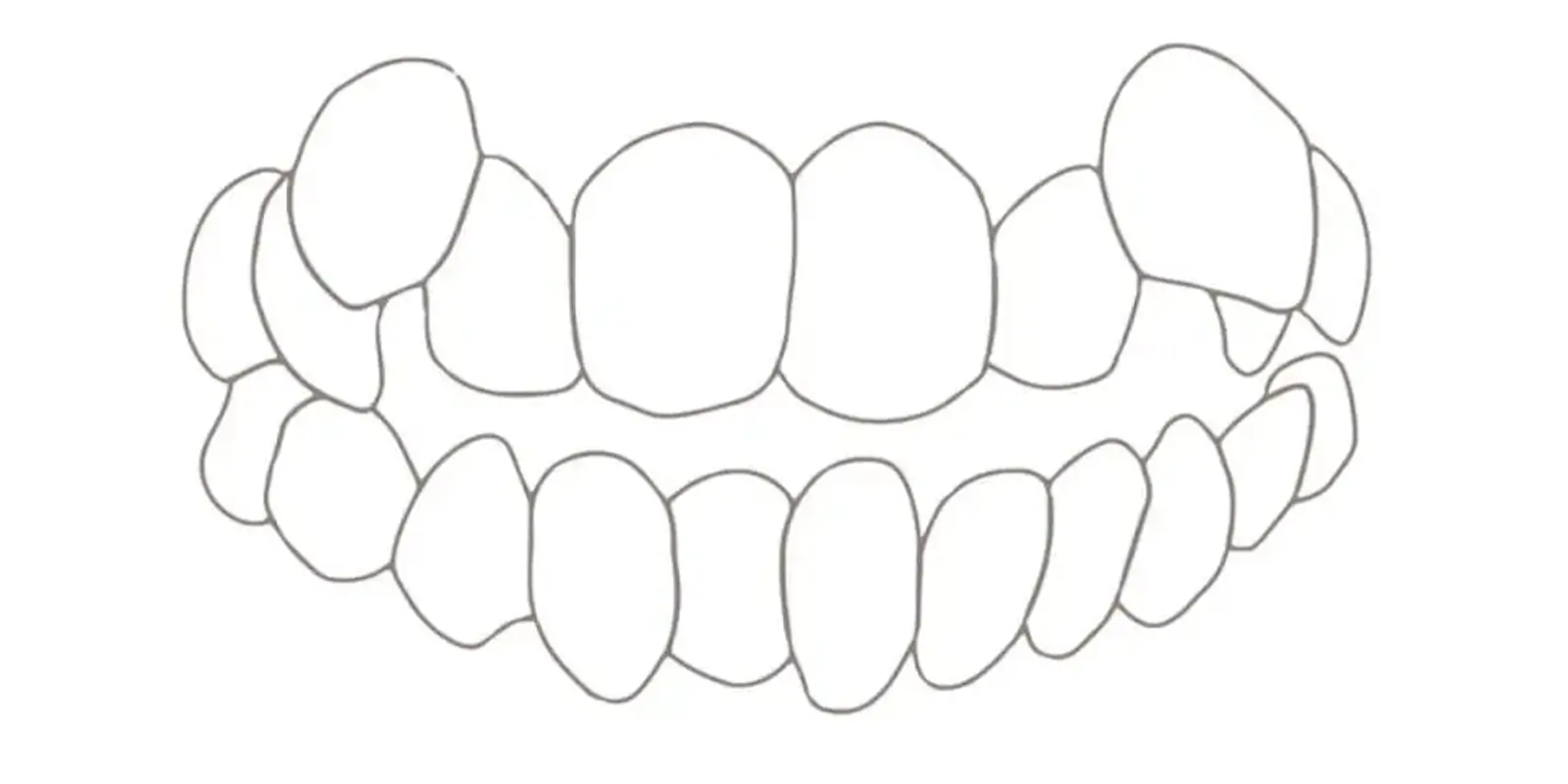八重歯（叢生）